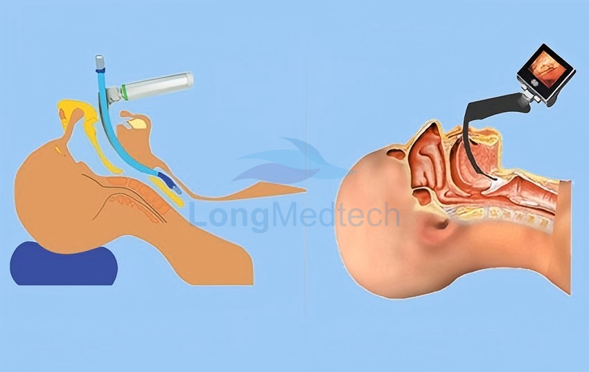 Почему видеоларингоскопы имеют значение