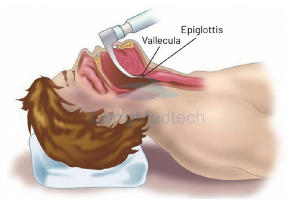 &iquest;Qu&eacute; es un videolaringoscopio?